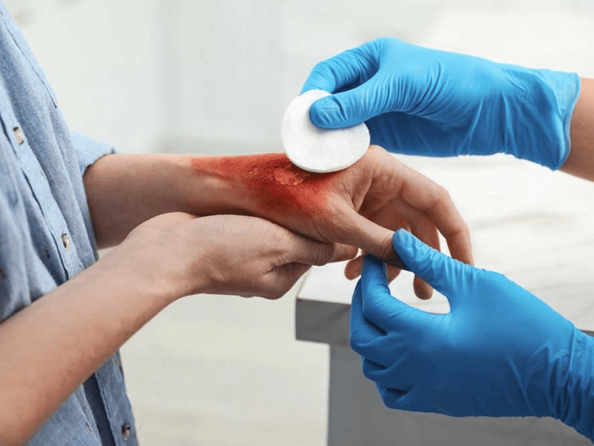 Охлаждение ожога водой